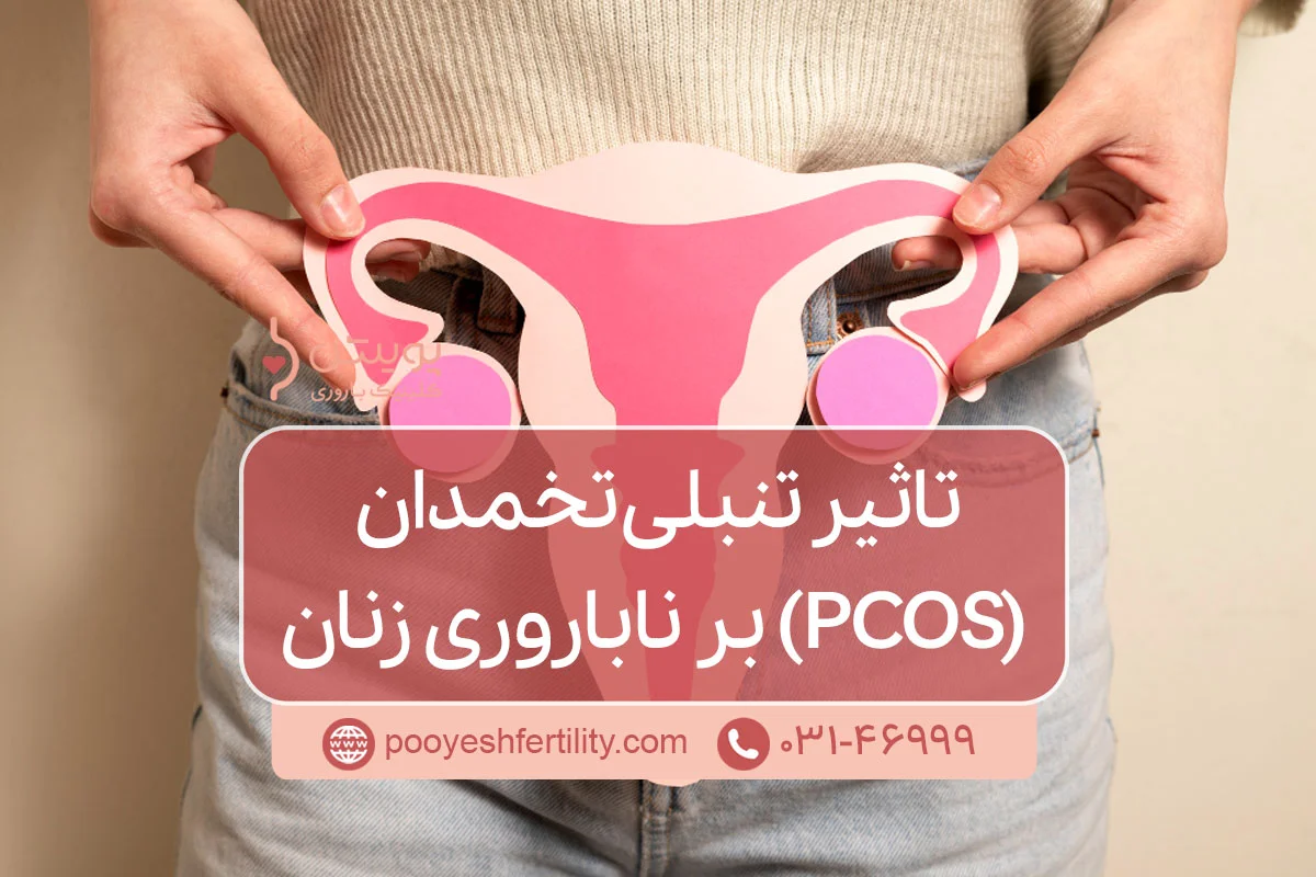 تاثیر تنبلی تخمدان (PCOS) بر ناباروری زنان