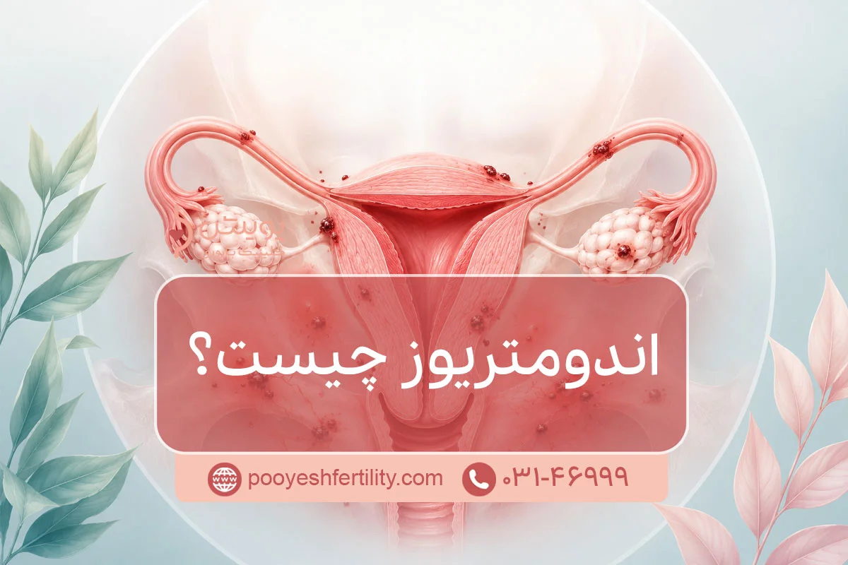 اندومتریوز چیست؟